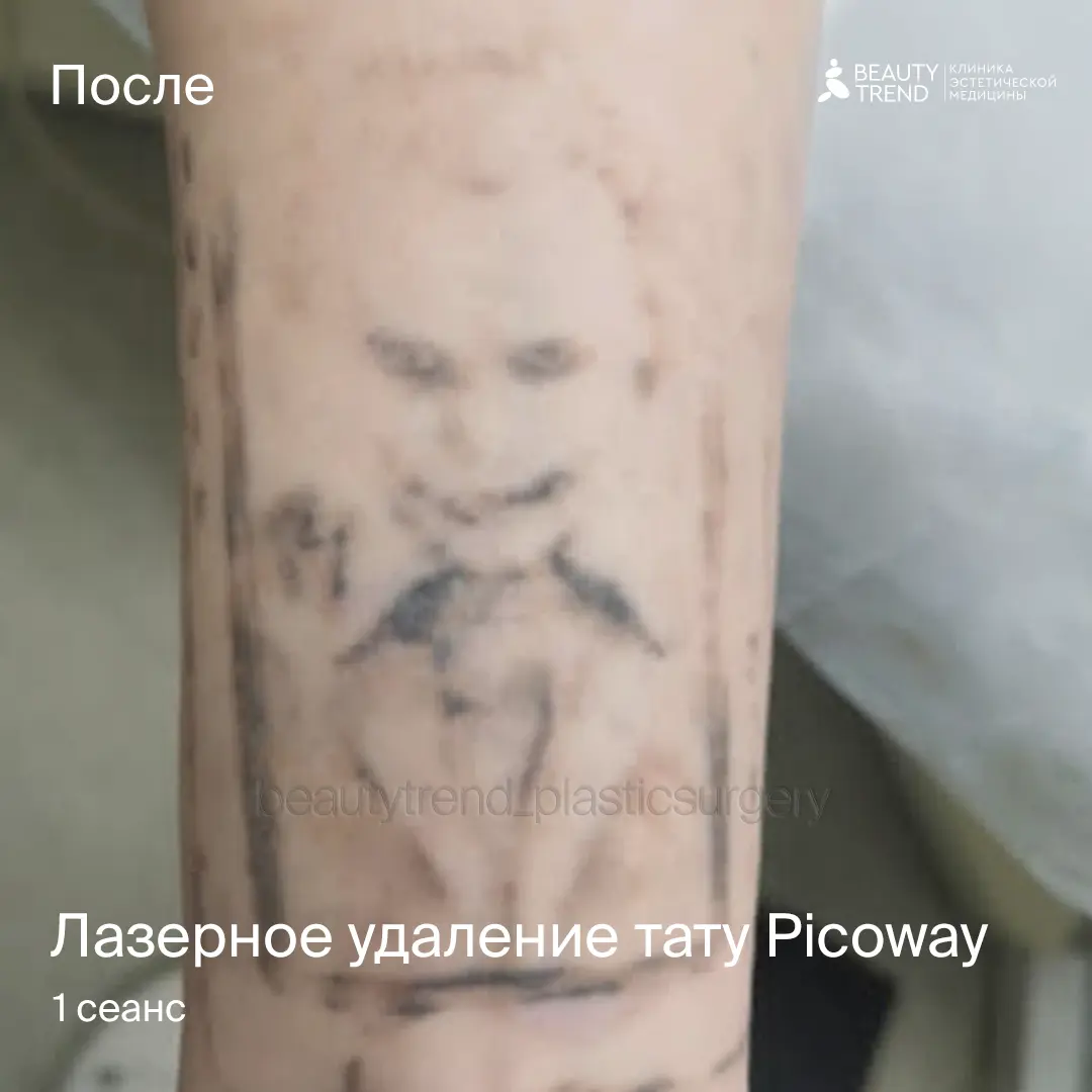 Удаление тату Picoway, 1С, работа после